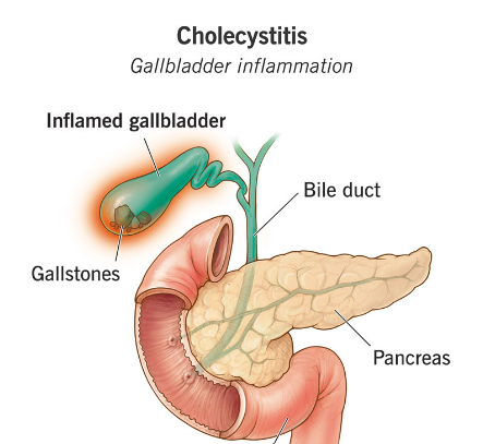 cholecystitis - Laparoscopic Surgeon Dr. Digant Pathak