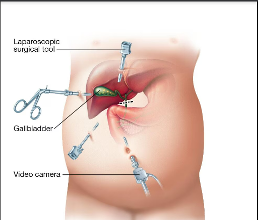 gallbladderlaproscopy 1 - Laparoscopic Surgeon Dr. Digant Pathak