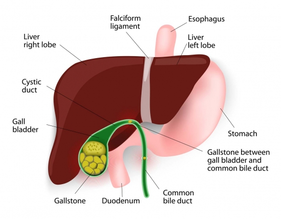 gallstones - Laparoscopic Surgeon Dr. Digant Pathak