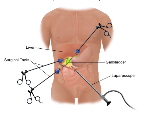 lapro edited - Laparoscopic Surgeon Dr. Digant Pathak