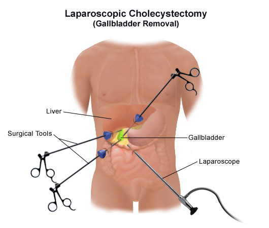 lapro - Laparoscopic Surgeon Dr. Digant Pathak
