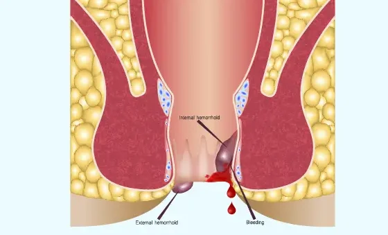 piles surgery edited - Laparoscopic Surgeon Dr. Digant Pathak