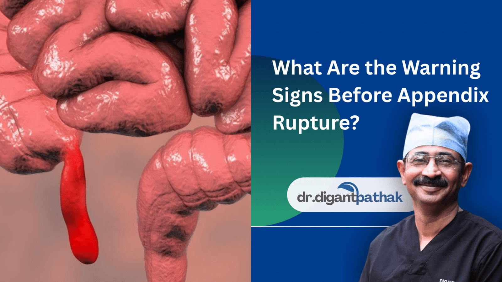 What Are the Warning Signs Before Appendix Rupture? - Dr. Digant Pathak