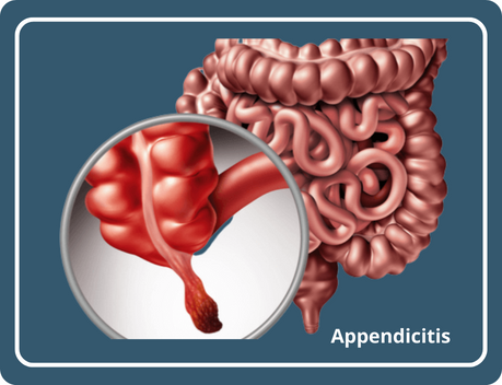 Appendicitis - Laparoscopic Surgeon Dr. Digant Pathak
