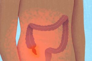 VWH MiraNorian InflamedAppendix Standard bb90643298a447a78e12c483cc5863f6 edited - Laparoscopic Surgeon Dr. Digant Pathak