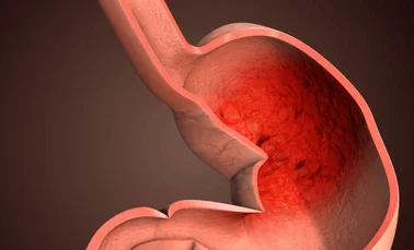 digestive disorder gastroesophageal reflux disease 260nw 2683001929 edited - Laparoscopic Surgeon Dr. Digant Pathak