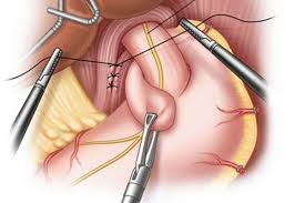 download 3 - Laparoscopic Surgeon Dr. Digant Pathak