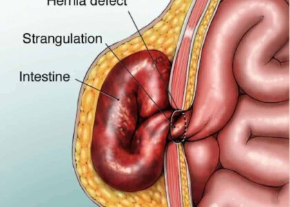 med strangulated h 1 - Laparoscopic Surgeon Dr. Digant Pathak