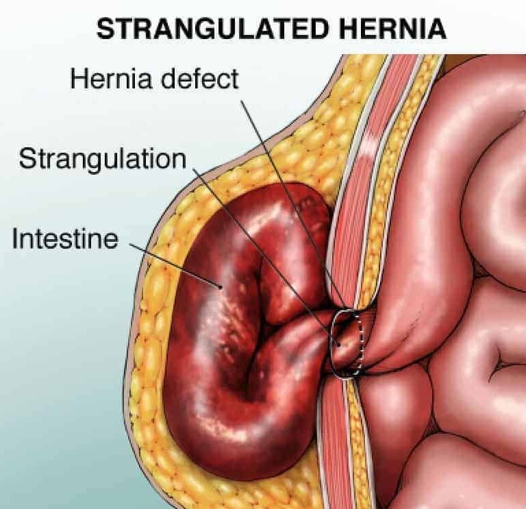 med strangulated h 1 edited 1 - Laparoscopic Surgeon Dr. Digant Pathak