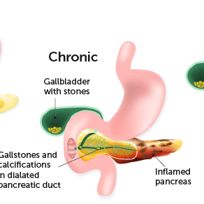 pancreatitis illustration edited 2 - Laparoscopic Surgeon Dr. Digant Pathak