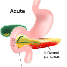 pancreatitis illustration edited - Laparoscopic Surgeon Dr. Digant Pathak