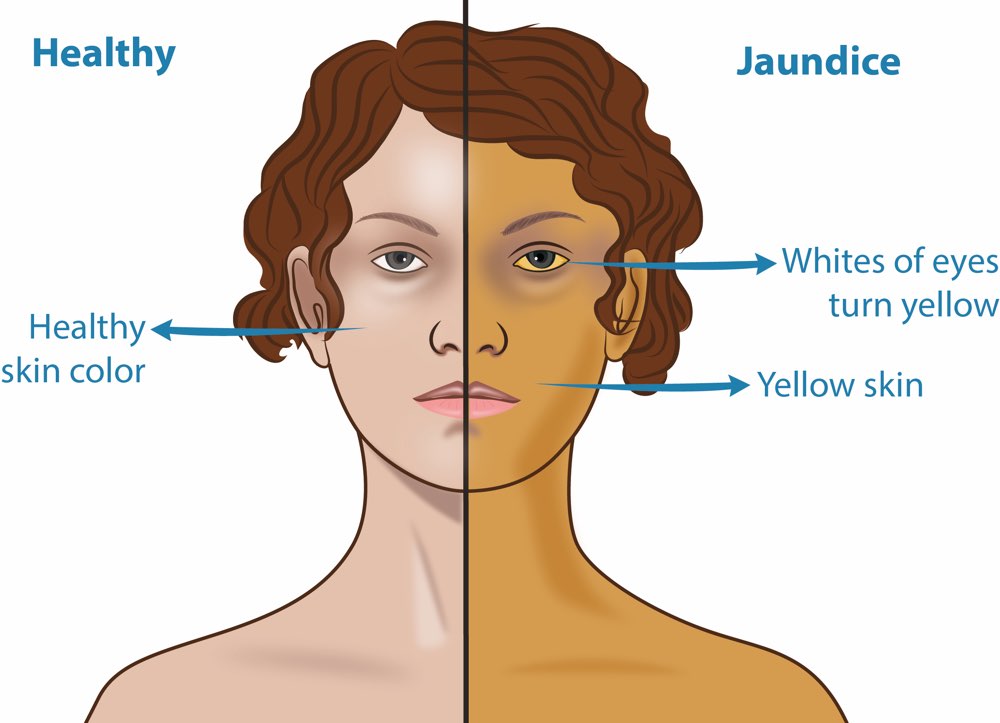 BRON jaundice perth - Laparoscopic Surgeon Dr. Digant Pathak