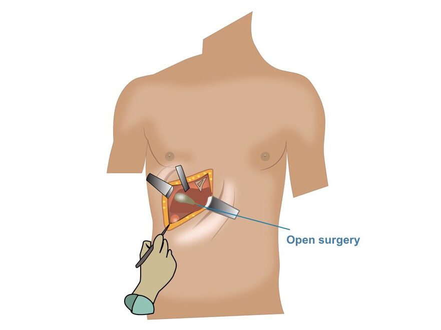 BRON open surgery perth edited - Laparoscopic Surgeon Dr. Digant Pathak