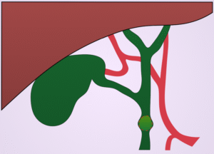 Choledocho - Laparoscopic Surgeon Dr. Digant Pathak