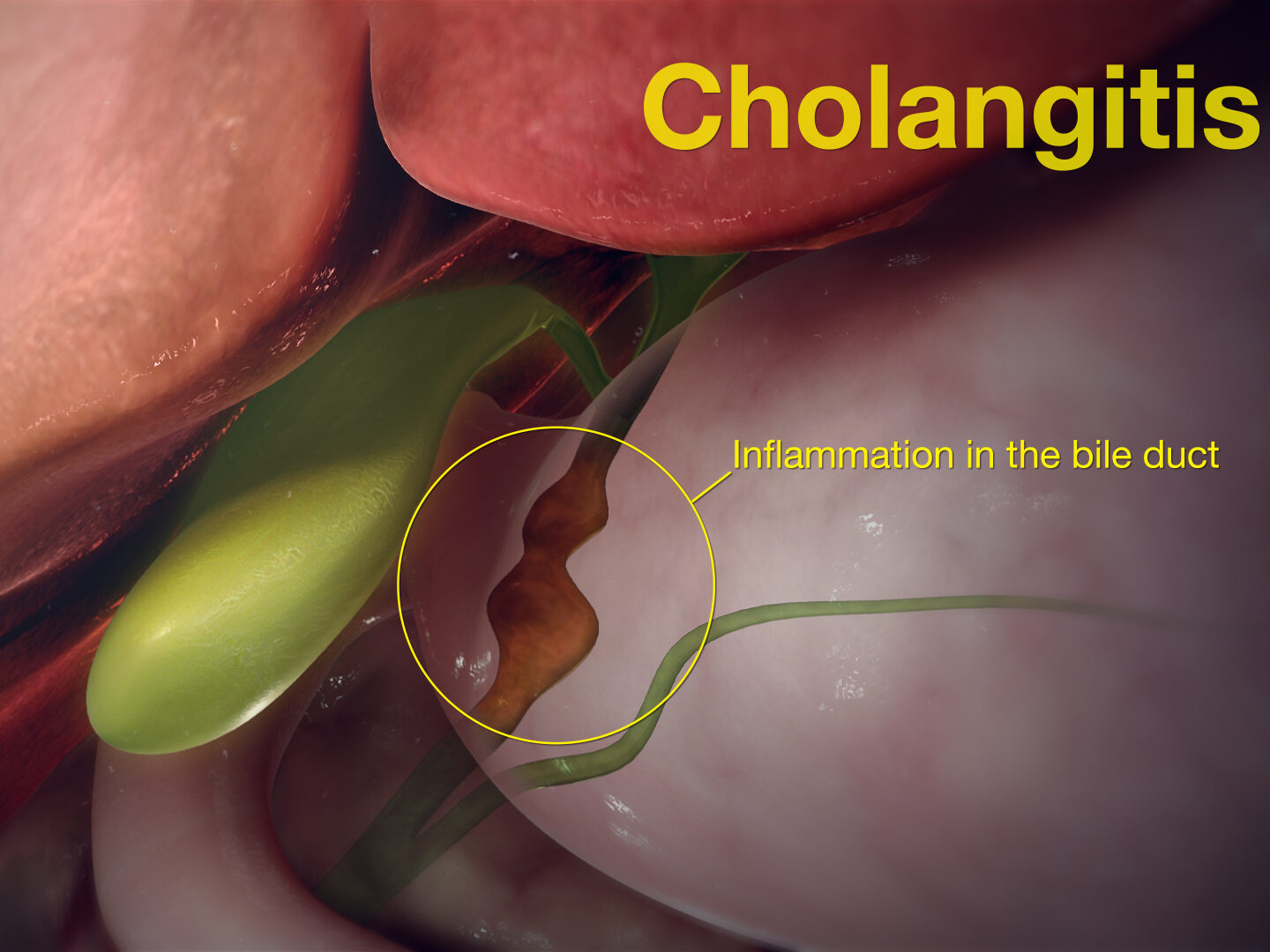 SAG Cholangitis 191015 01 edited - Laparoscopic Surgeon Dr. Digant Pathak