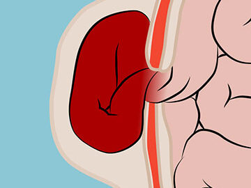 strangulated hernia edited - Laparoscopic Surgeon Dr. Digant Pathak