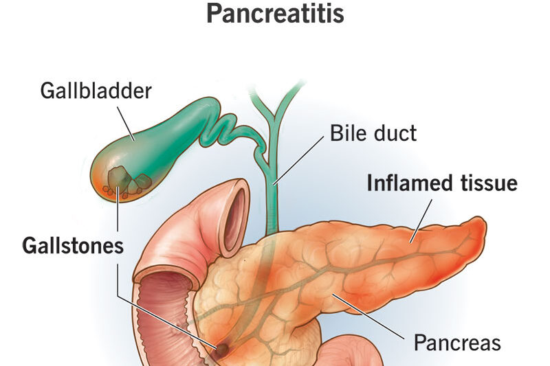 8103 pancreatitis illustration edited 2 - Laparoscopic Surgeon Dr. Digant Pathak