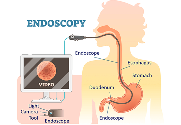 endoscopic procedure illustration - Laparoscopic Surgeon Dr. Digant Pathak