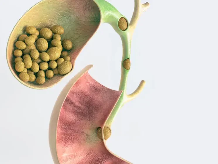 gallbladder disease gallstones edited - Laparoscopic Surgeon Dr. Digant Pathak