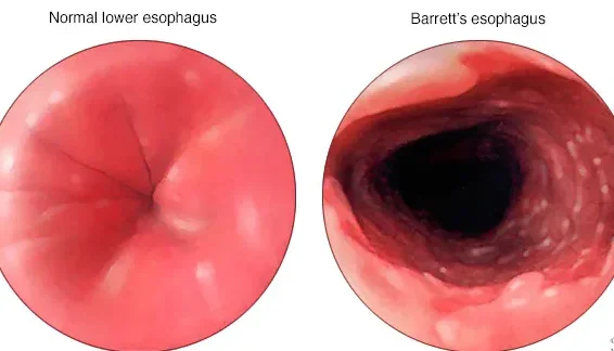 hq00312 im04111 mcdc7 barretts diagnosisthu jpg edited 1 - Laparoscopic Surgeon Dr. Digant Pathak