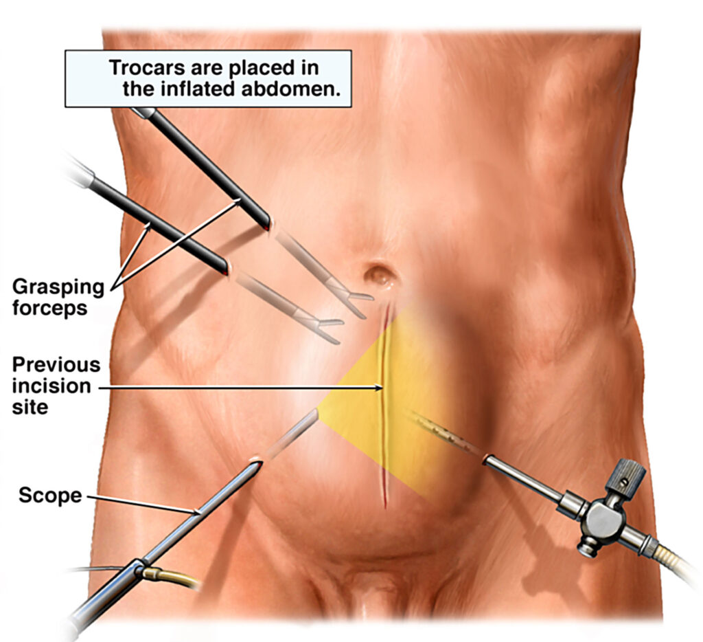 laparoscopy hernia repair - Laparoscopic Surgeon Dr. Digant Pathak