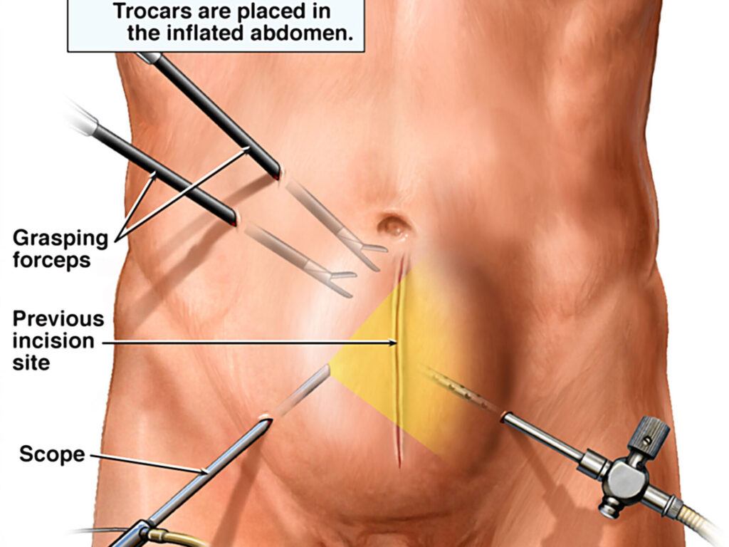 laparoscopy hernia repair edited - Laparoscopic Surgeon Dr. Digant Pathak