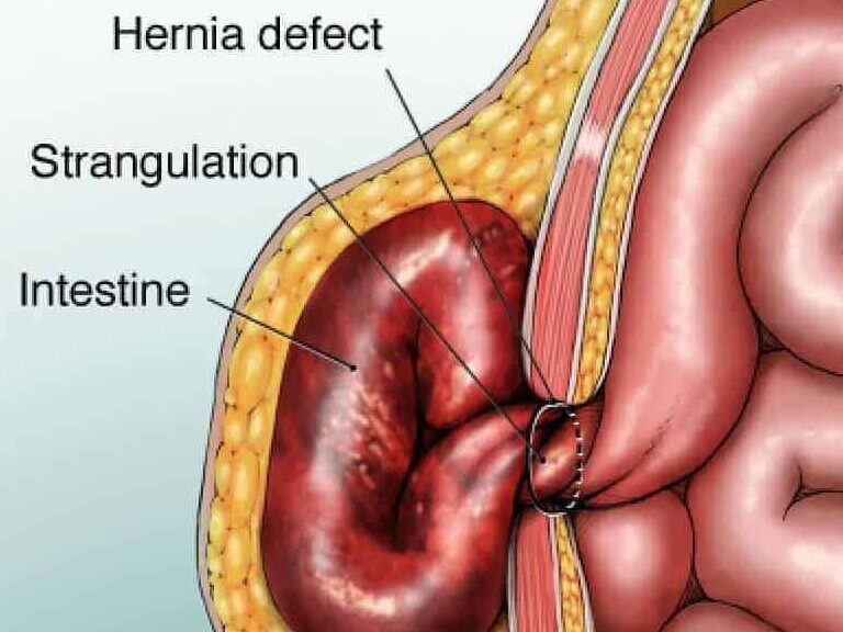 med strangulated h 1 edited - Laparoscopic Surgeon Dr. Digant Pathak