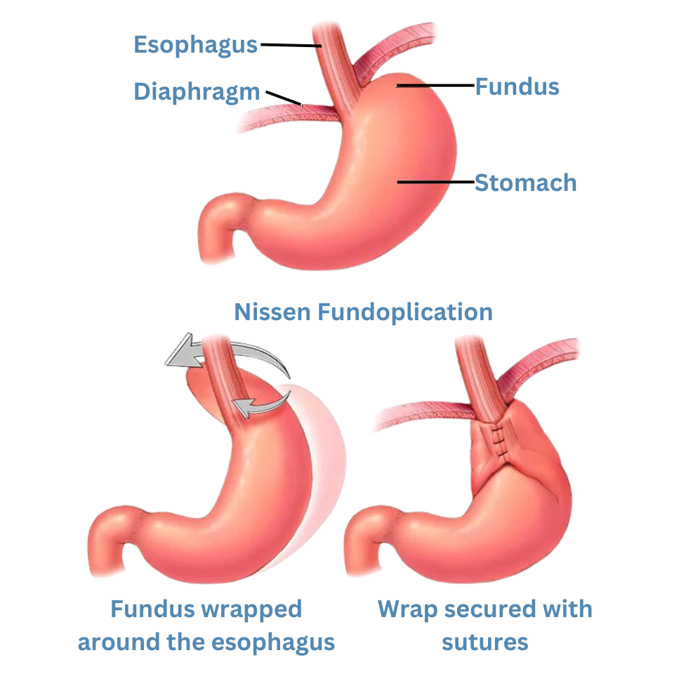 5 1 edited 1 - Laparoscopic Surgeon Dr. Digant Pathak