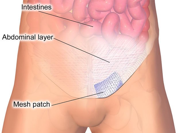 Inguinal Hernia Patch edited - Laparoscopic Surgeon Dr. Digant Pathak