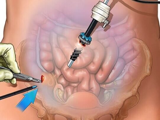 surgerympain4 1 edited - Laparoscopic Surgeon Dr. Digant Pathak